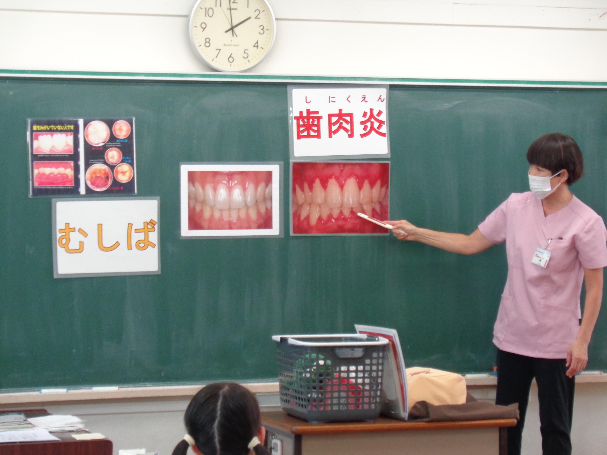 歯科衛生士さんのお話